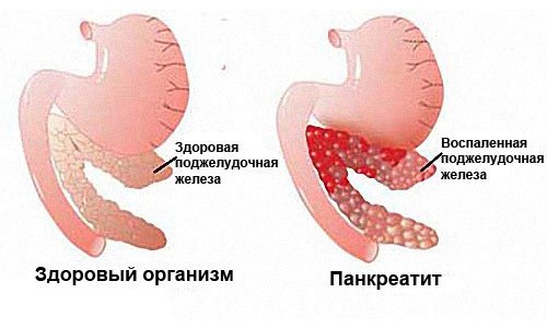 Первые признаки панкреатита поджелудочной железы thumbnail