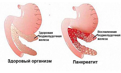 причины панкреатита